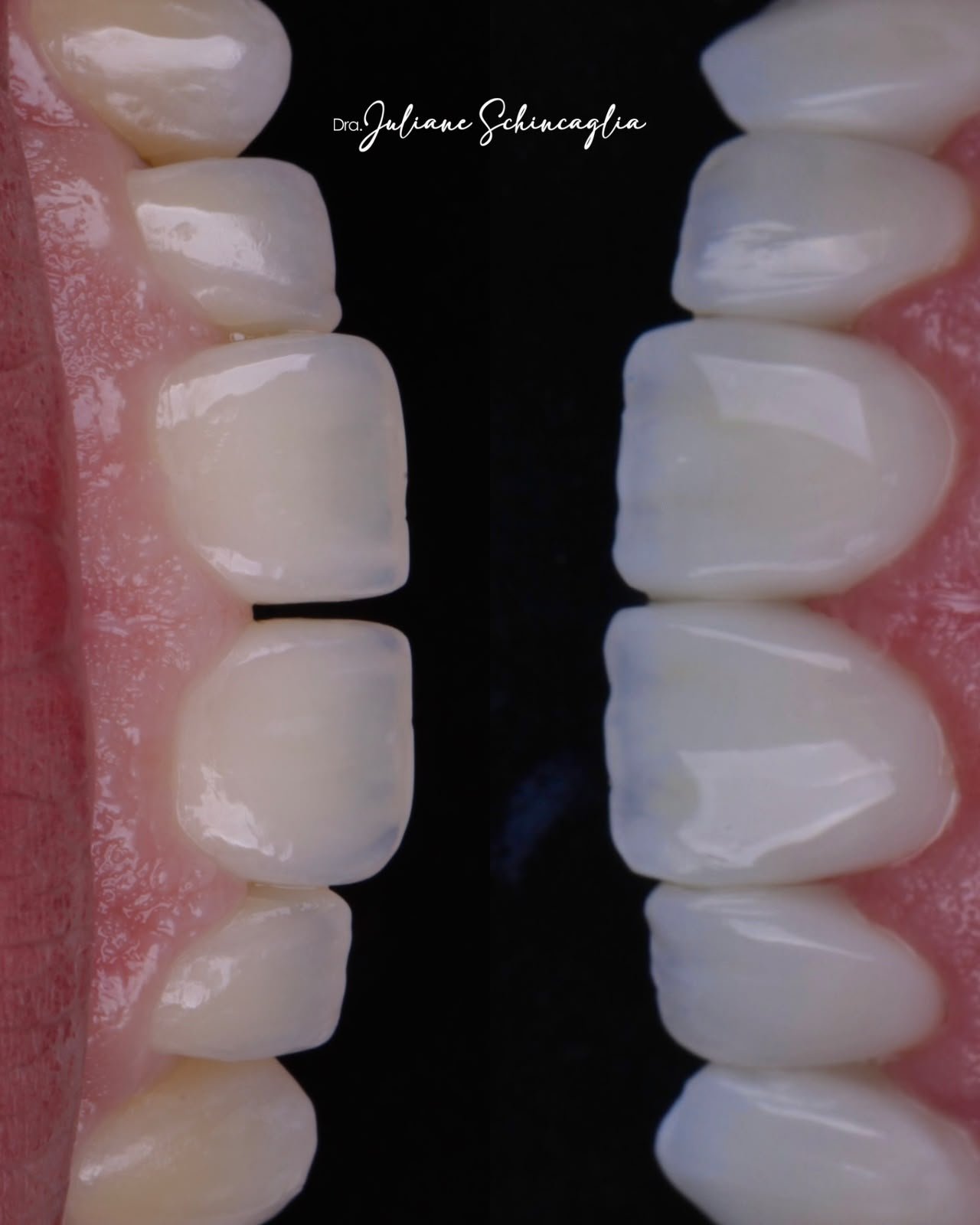Antes e depois de lentes em resina
