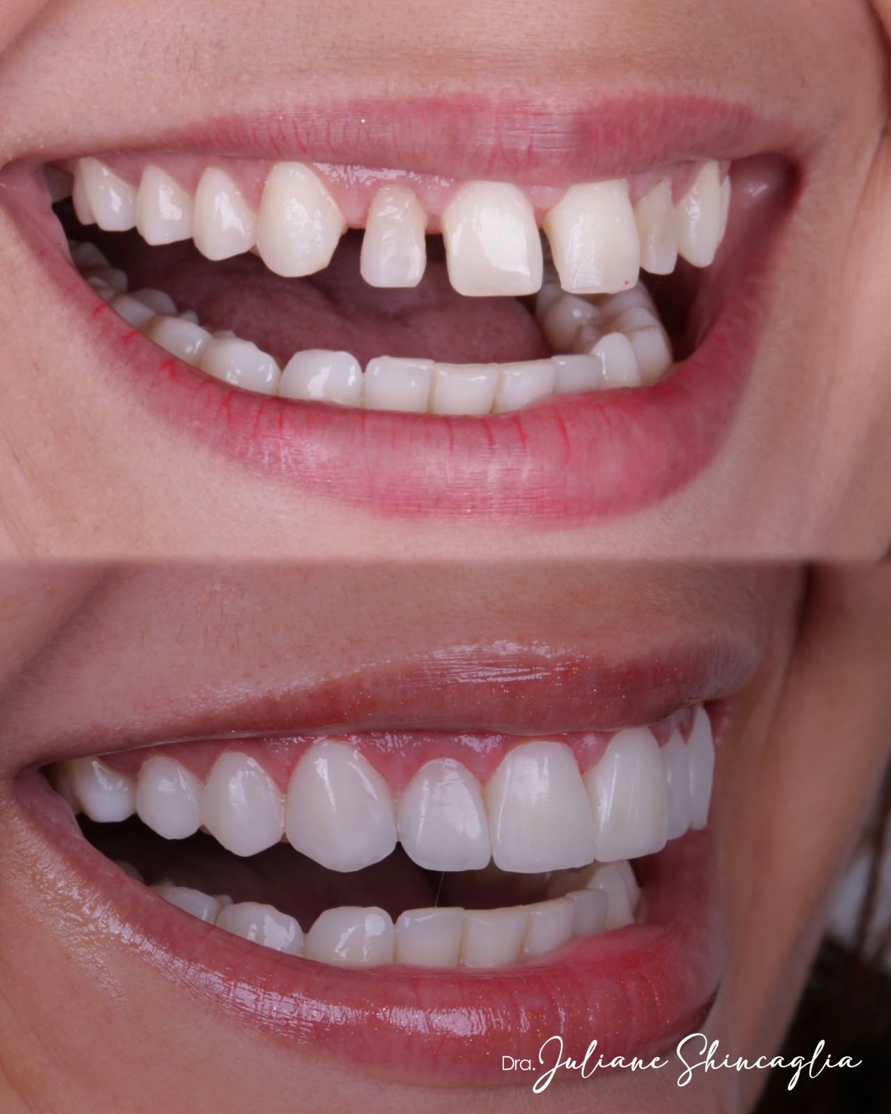 Antes e depois de lentes em resina